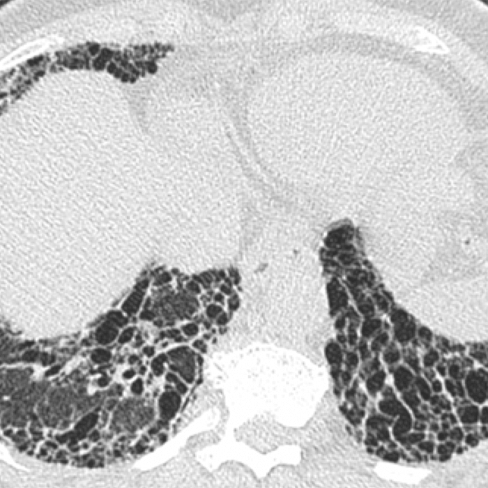 Lung Function Decline Prediction